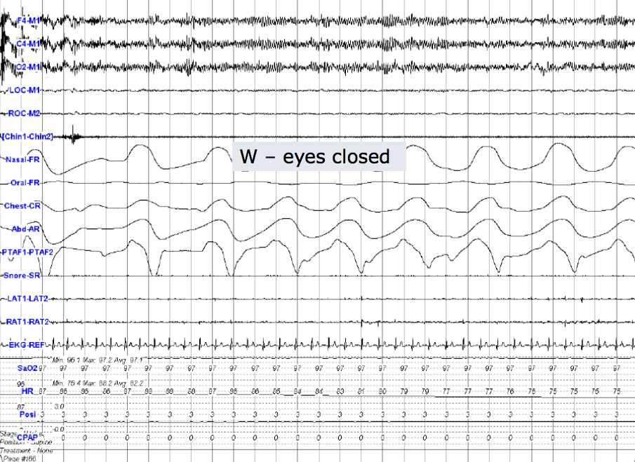 Clinique Somnomed EEG Wake