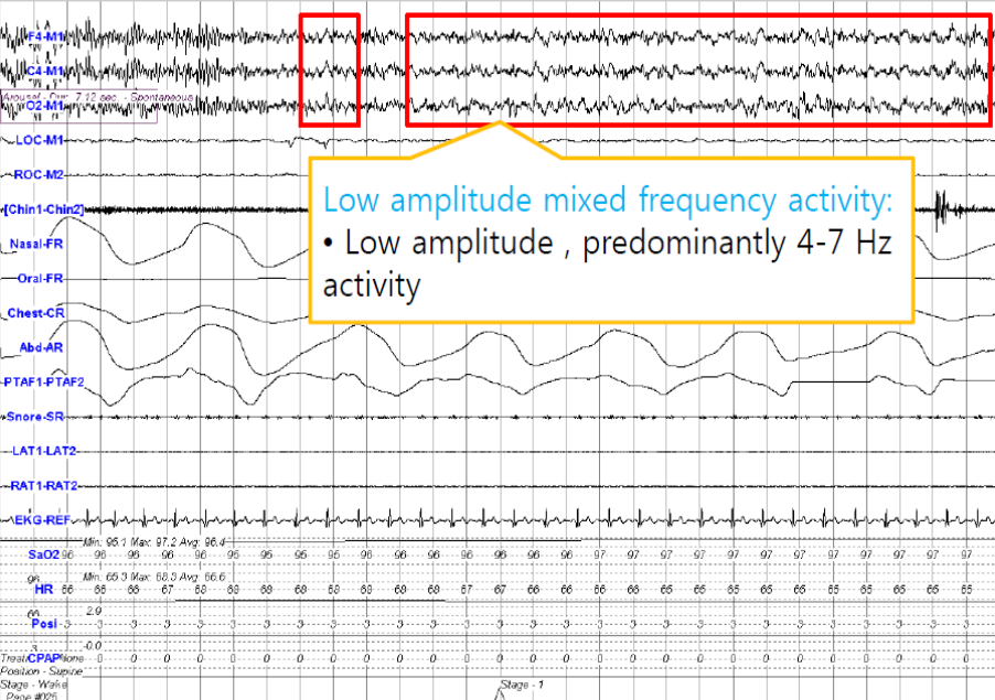 Clinique Somnomed EEG N1
