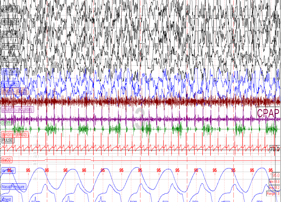 Clinique Somnomed EEG N3